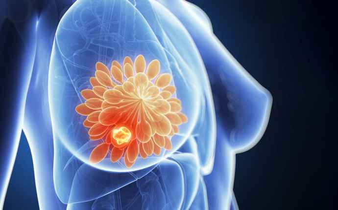 Nordiskt webbinarium om bröstcancer