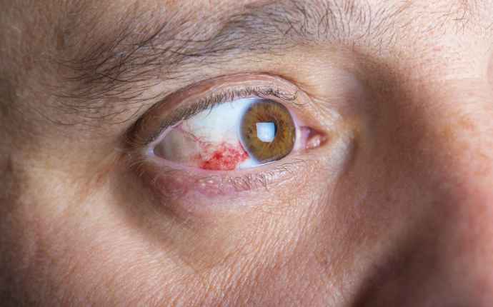 Ögonkomplikationer som kan uppstå vid både typ 1- och typ 2-diabetes