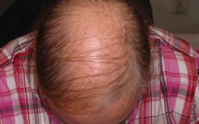 Androgen alopeci - Manligt håravfall börjar med att håret vid tinningarna följt av att håret blir tunnare, även på toppen av huvudet
