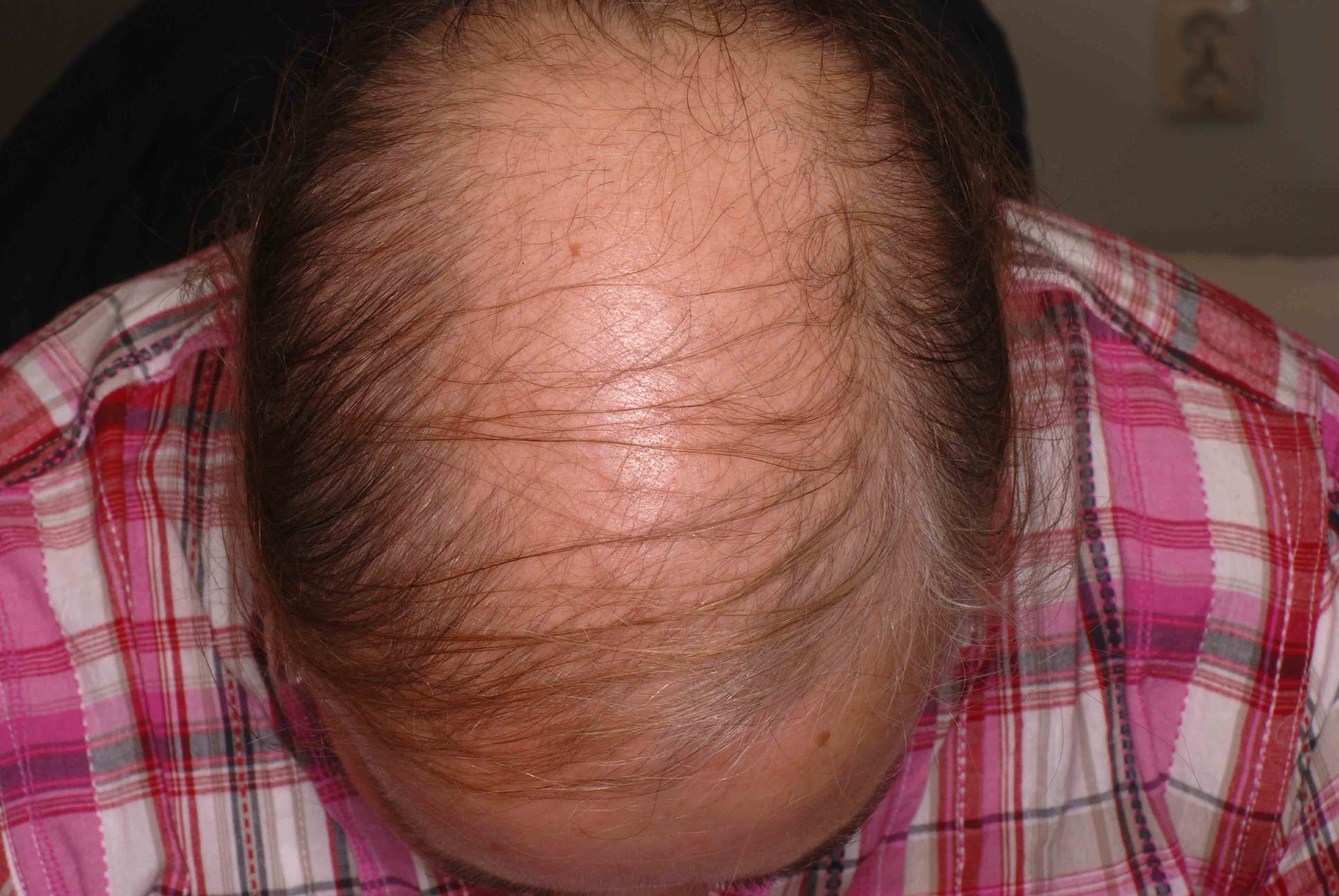 Androgen alopeci - Manligt håravfall börjar med att håret vid tinningarna följt av att håret blir tunnare, även på toppen av huvudet