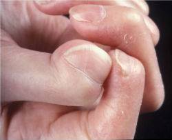 Bild av akroosteolys i fingrar (systemisk skleros/sklerodermi)