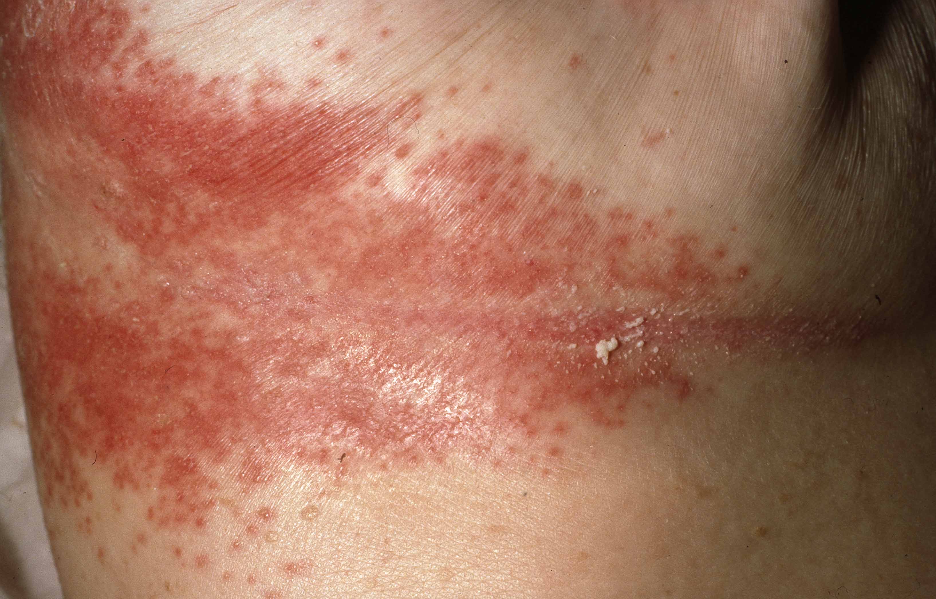 Candida – en av de vanligaste svampinfektionerna i huden
