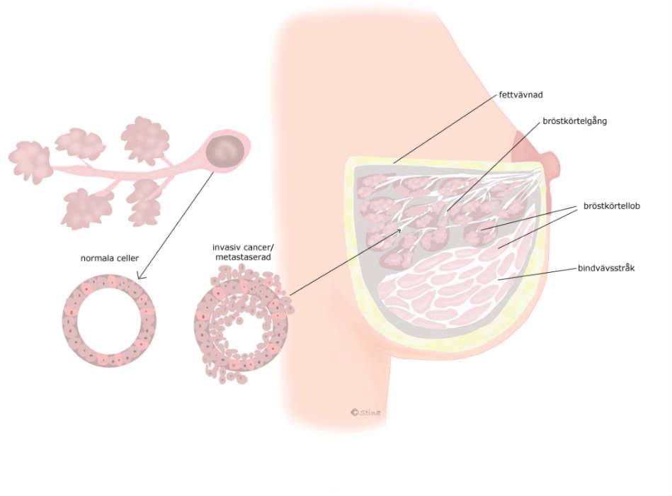 Bröstcancer (invasiv)