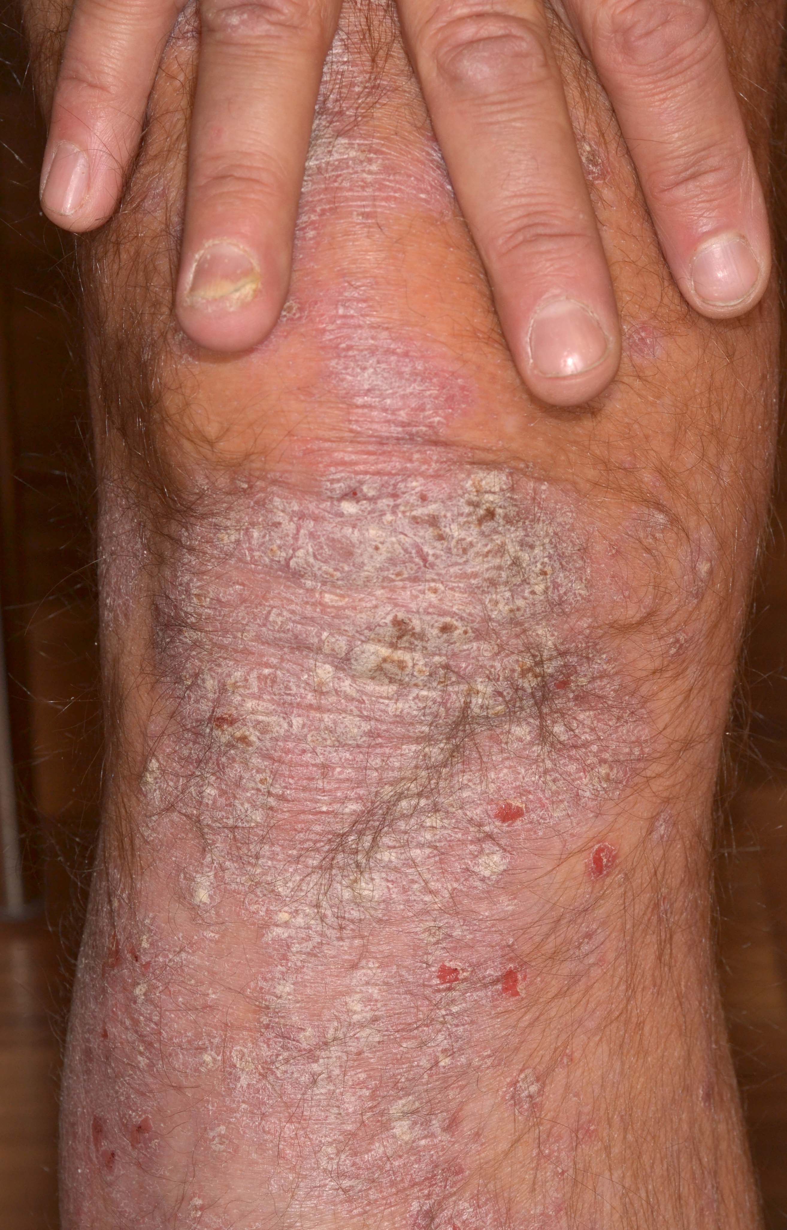 Plackpsoriasis på knä samt nagelpsoriasis