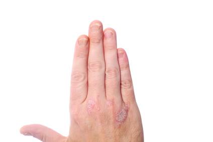 Psoriasis på handen med små fjälliga hudpartier omväxlande med hårda och tjockare partier