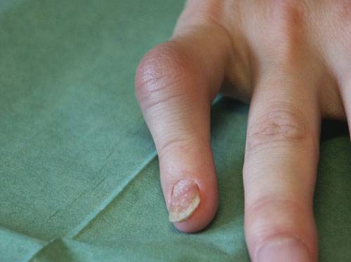 artros i fingerleder