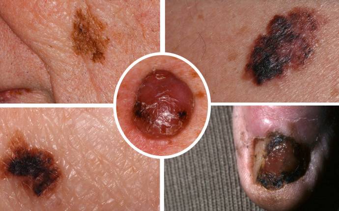 Bilder på malignt melanom – så ser ett onormalt nevus ut