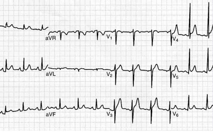 Akut perikardit (EKG-bild)