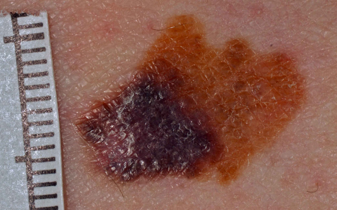 Bild på malignt melanom - hudcancer