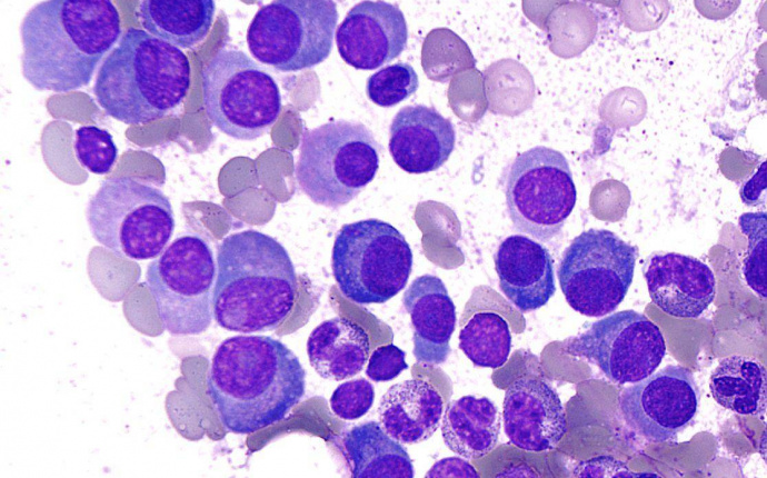 Multipelt myelom - medicinsk översikt av blodcancersjukdomen