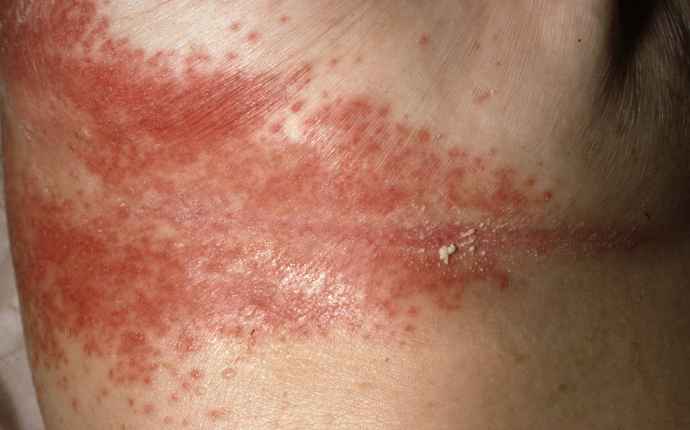 Candida – en av de vanligaste svampinfektionerna i huden