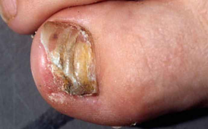Nagelsvamp - tånageln är förtjockad, missfärgad och porös och kräver en svampodling.