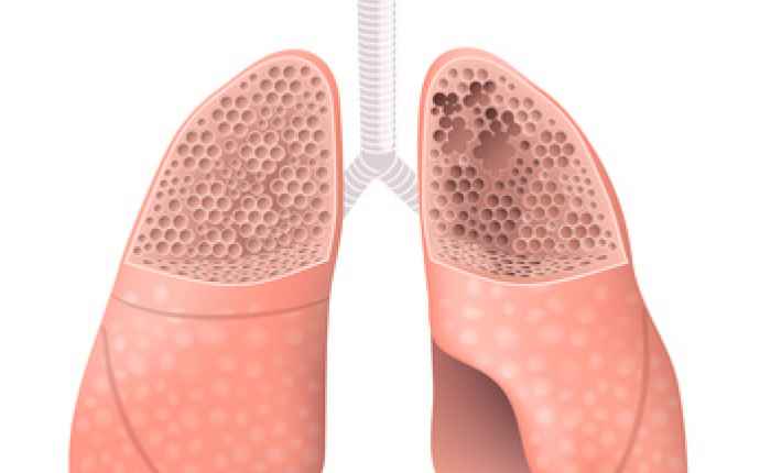 Till vänster en frisk lunga och till höger en lunga med emfysemutveckling, som är typiskt vid KOL, kroniskt obstruktiv lungsjukdom