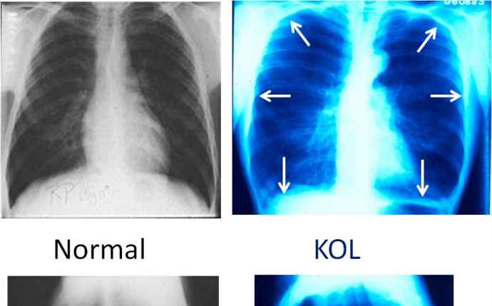 KOL - lungröntgen jämförelse