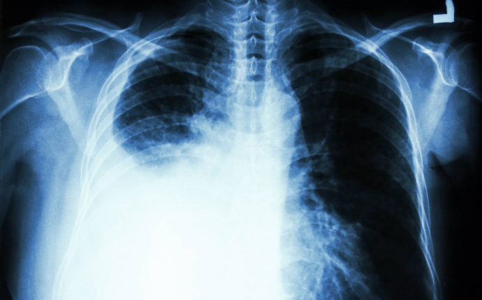 Nytt patientfall om skelettmetastaser vid lungcancer
