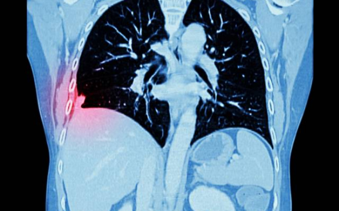 Lungcancer – en kongressrapport från ESMO 2021