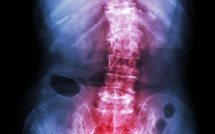 AS - Inflammatorisk ryggsjukdom och ankyloserande spondylit (AS) - medicinsk översikt