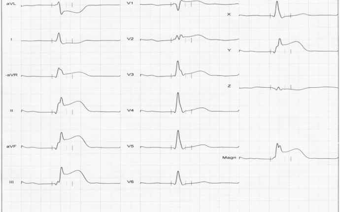 Akut hjärtinfarkt (EKG-bild)