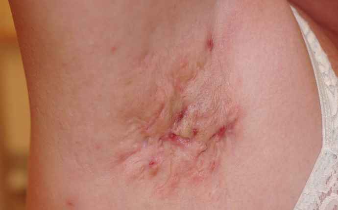 Hidradenitis suppurativa (HS) med lesioner av knutor, abscesser och fistlar i armhåla