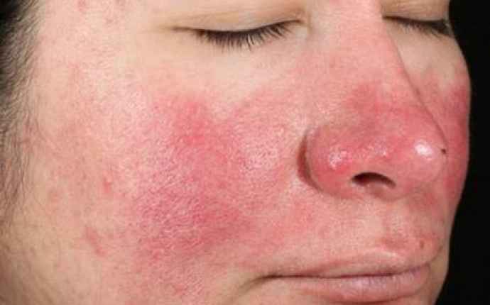Rosacea, en långvarig hudsjukdom som engagerar de centrala delarna av ansiktet