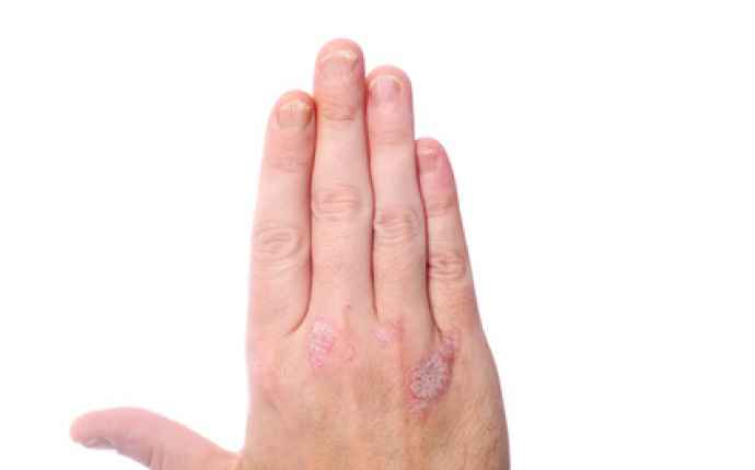 Psoriasis på handen med små fjälliga hudpartier omväxlande med hårda och tjockare partier