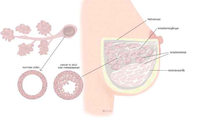 Bröstcancer (CIS)