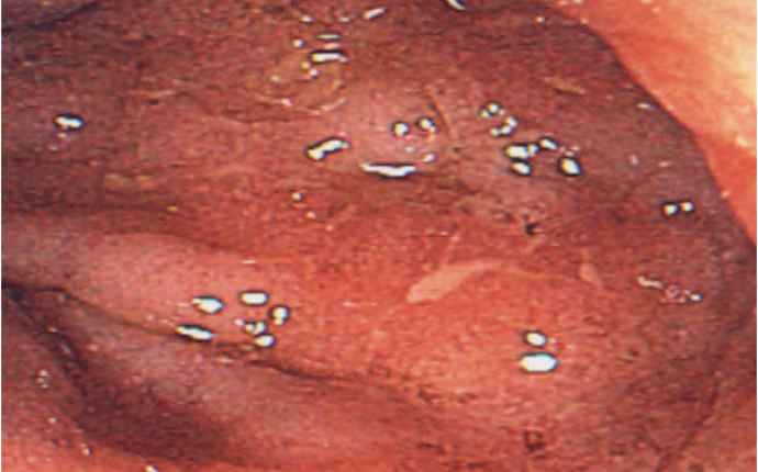 Ulcerös kolit, måttligt eroderad slemhinna