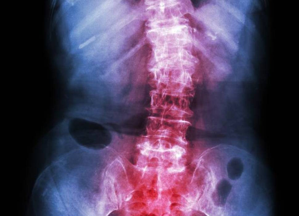 AS - Inflammatorisk ryggsjukdom och ankyloserande spondylit (AS) - medicinsk översikt