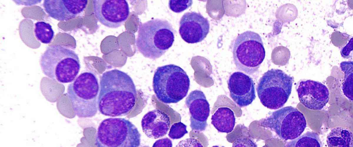 Multipelt myelom - medicinsk översikt av blodcancersjukdomen