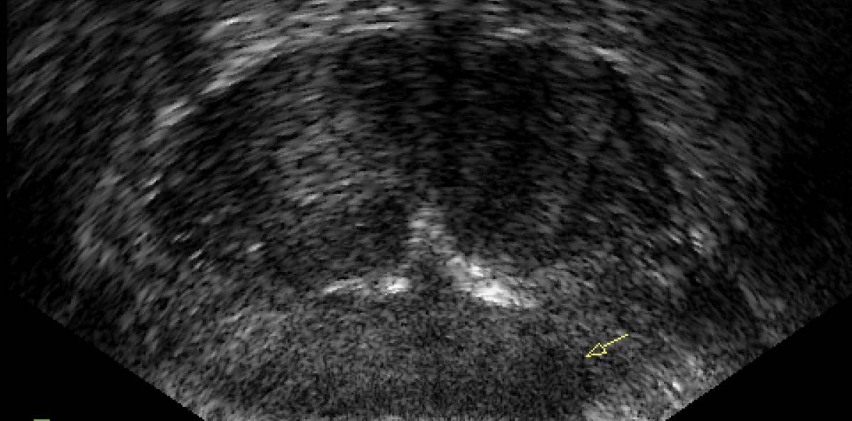Prostatacancer - transrektalt ultraljud