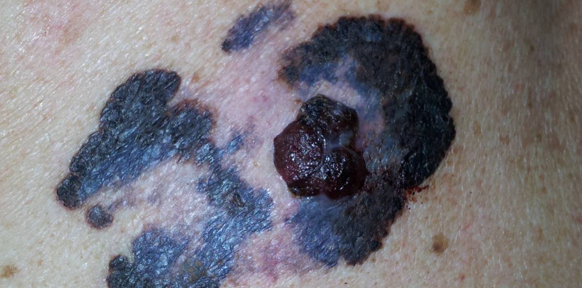 Immunterapi vid malignt melanom