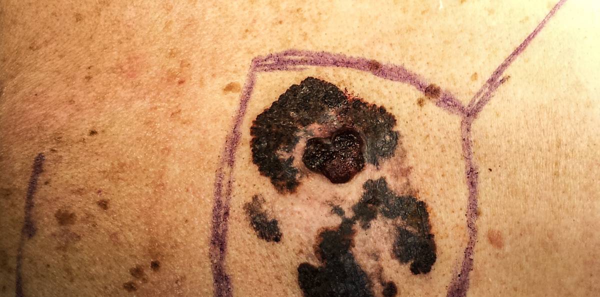 Ny läkemedelskombo imponerar vid metastaserat melanom