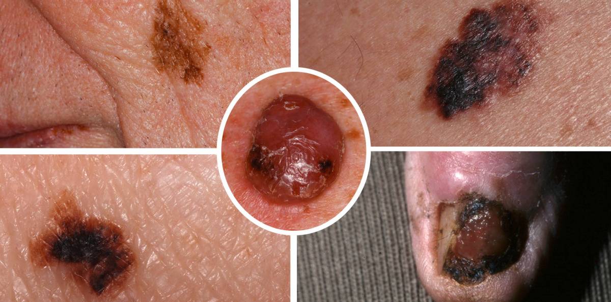 Bilder på malignt melanom – så ser ett onormalt nevus ut