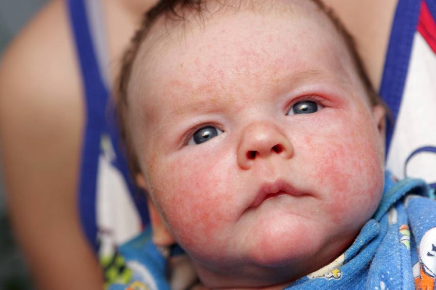 Hos spädbarn visar sig atopiskt eksem sig som kliande röda utslag på kinderna, som sprider sig ner på halsen och i blöjregionen