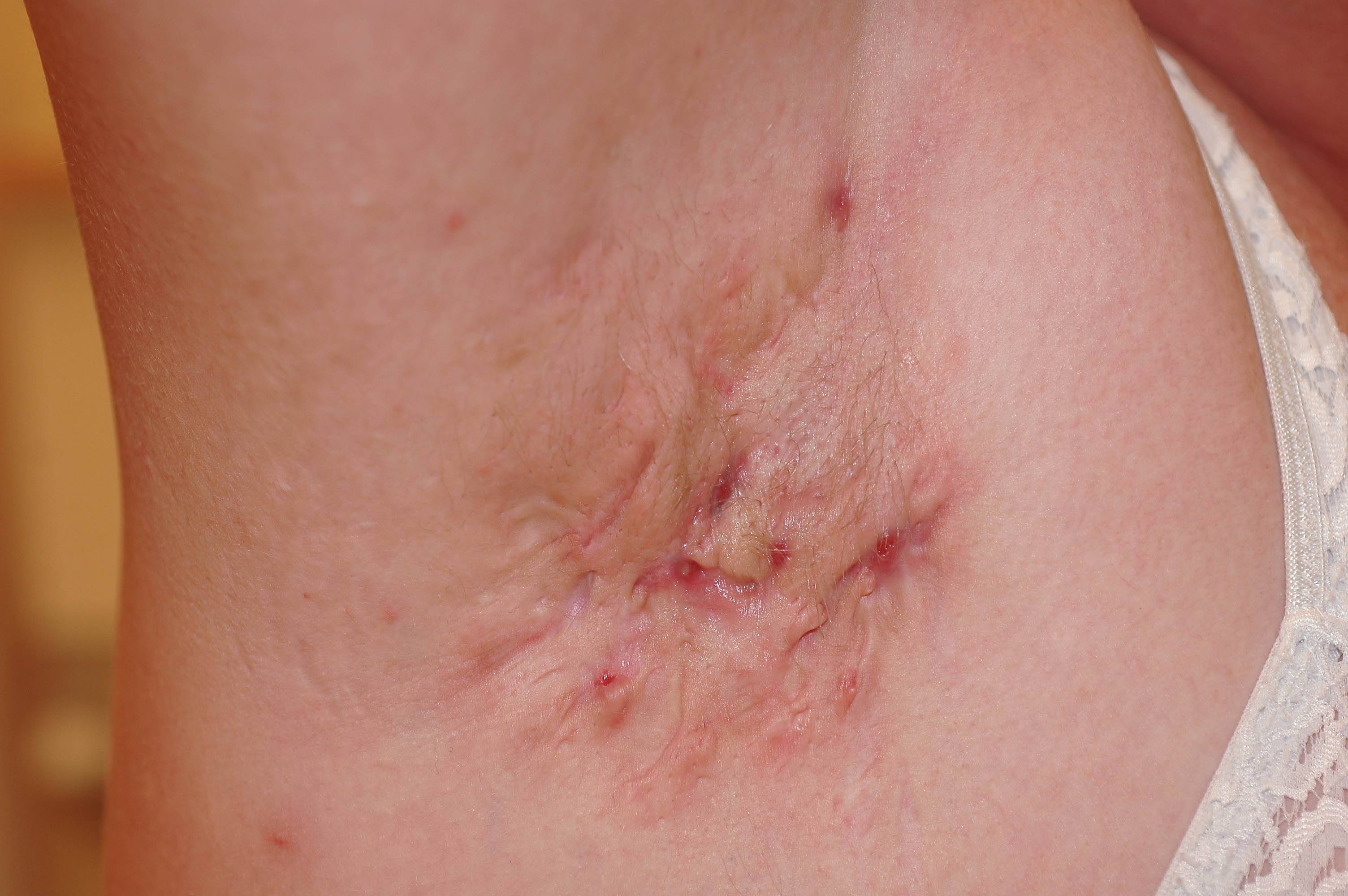 Hidradenitis suppurativa (HS) med lesioner av knutor, abscesser och fistlar i armhåla
