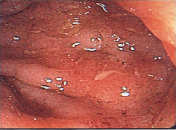 Ulcerös kolit, måttligt eroderad slemhinna