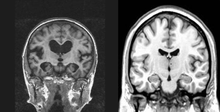 MRT-bild vid Alzheimers sjukdom