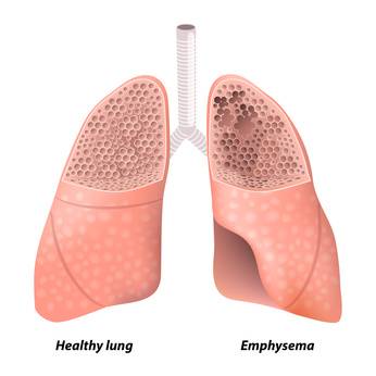 Till vänster en frisk lunga och till höger en lunga med emfysemutveckling, som är typiskt vid KOL, kroniskt obstruktiv lungsjukdom