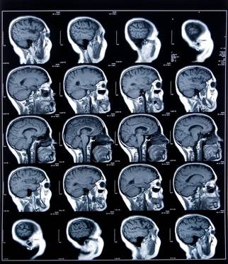 MRT-röntgen – Magnetresonanstomografi, MRT, av hjärnvävnad