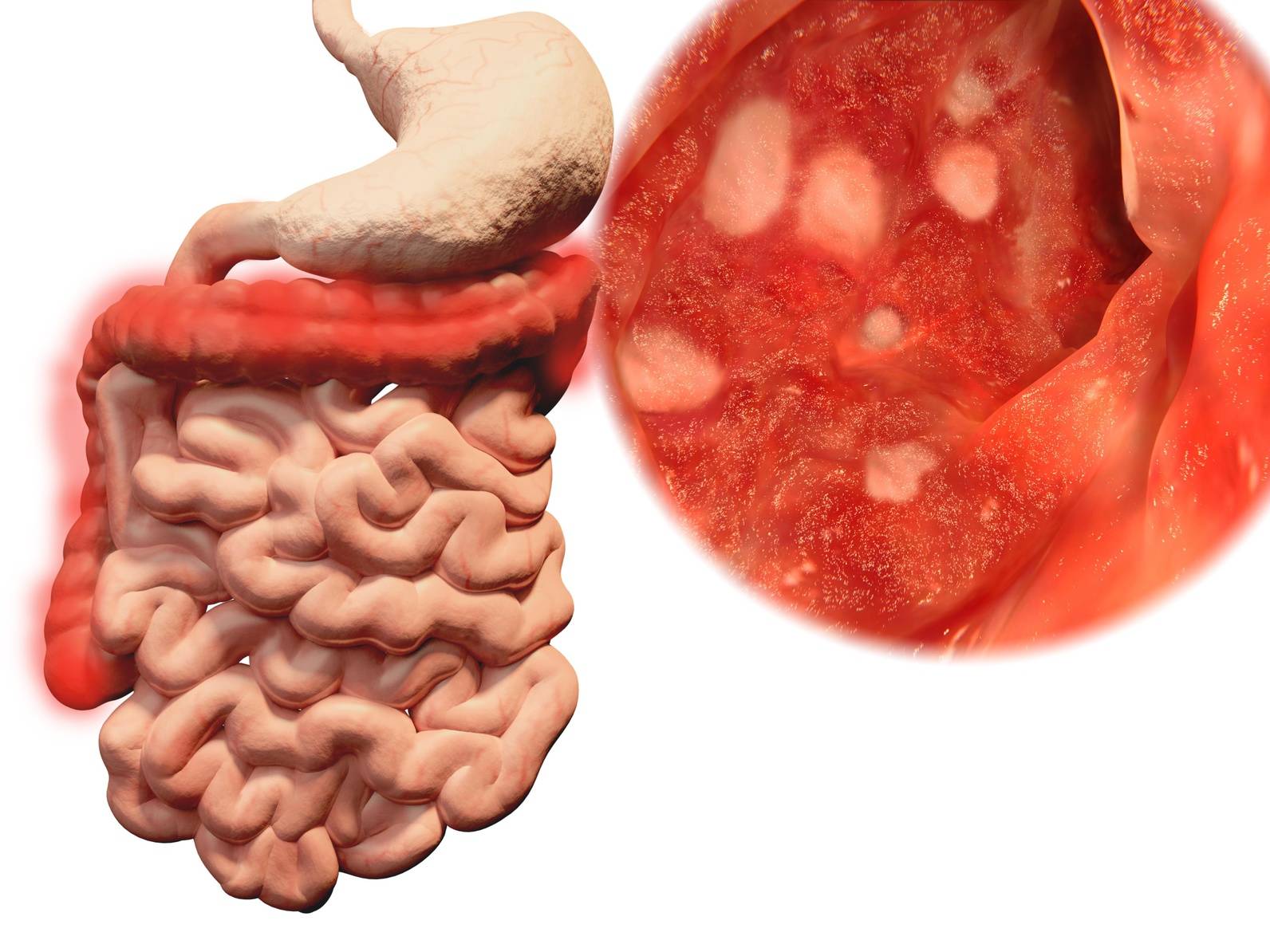 Ulcerös kolit – kronisk inflammation i tarmens slemhinna