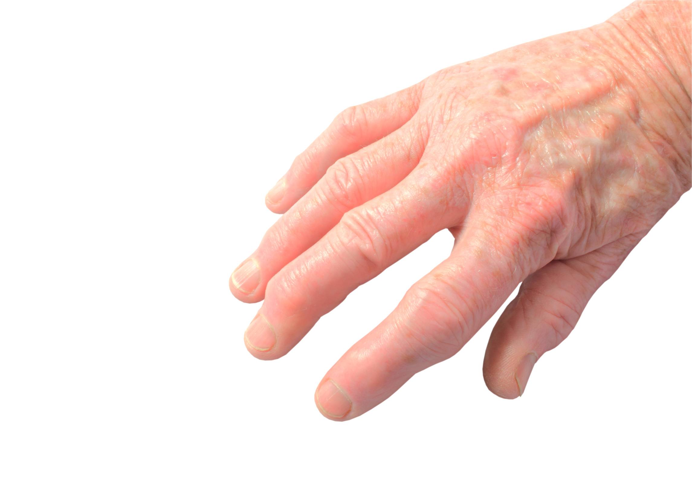 Psoriasisartrit (PsA) i fingrar