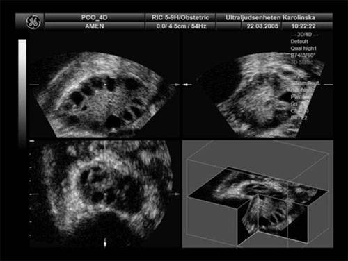 Typisk ultraljudsbild av ett polycystiskt ovarium (PCOS)