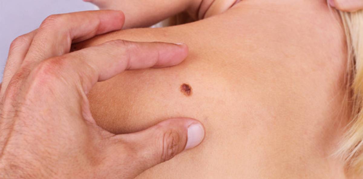 Malignt melanom är en av de allra vanligaste hudcancerformerna